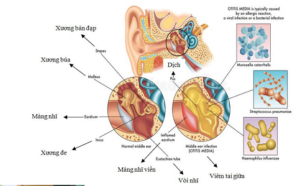 Bệnh Viêm Tai Giữa Và Những Điều Cần Biết