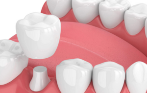 LÀM THẾ NÀO ĐỂ HẾT SÂU RĂNG CÓ NHỮNG CÁCH ĐIỀU TRỊ NÀO